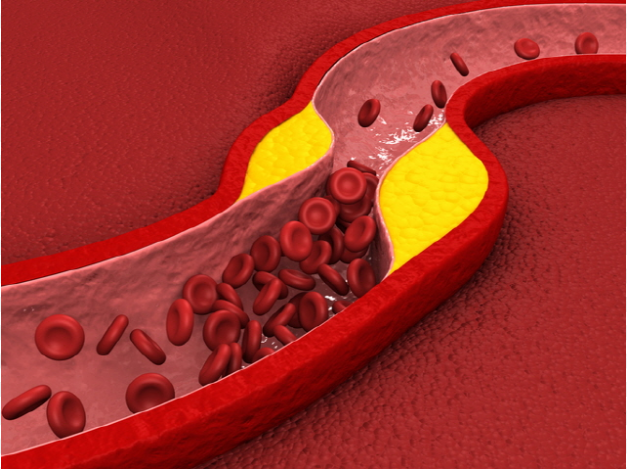 동맥경화 증상과 원인 BEST 심혈관 질환 예방법